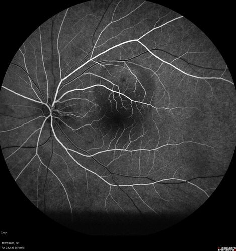 Central Serous Retinopathy - Female on steroids
35 year old female Noticed blurred vision when waking up in the morning.  Also, vision blacks out for a few seconds when she gets up quickly. About 3 months ago she had a history of intermittent vomiting.

VA 20/20 OD, 20/25 OS

MRI normal,  MRA showed lateral sinus thrombosis.  Lupus anticoagulant was positive
