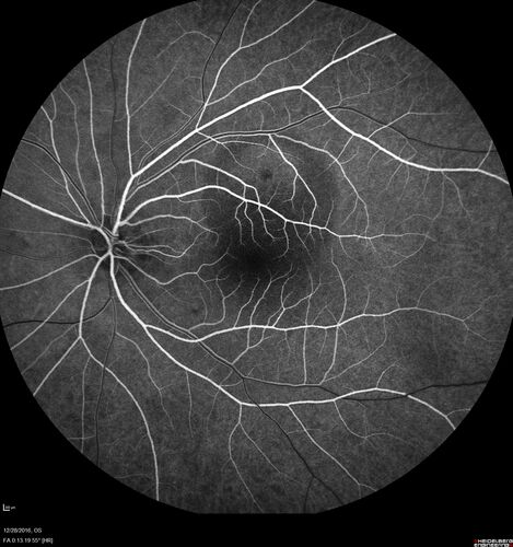Central Serous Retinopathy - Female on steroids
35 year old female Noticed blurred vision when waking up in the morning.  Also, vision blacks out for a few seconds when she gets up quickly. About 3 months ago she had a history of intermittent vomiting.

VA 20/20 OD, 20/25 OS

MRI normal,  MRA showed lateral sinus thrombosis.  Lupus anticoagulant was positive
