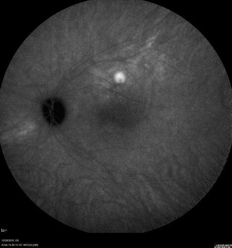Central Serous Retinopathy - Female on steroids
35 year old female Noticed blurred vision when waking up in the morning.  Also, vision blacks out for a few seconds when she gets up quickly. About 3 months ago she had a history of intermittent vomiting.

VA 20/20 OD, 20/25 OS

MRI normal,  MRA showed lateral sinus thrombosis.  Lupus anticoagulant was positive
