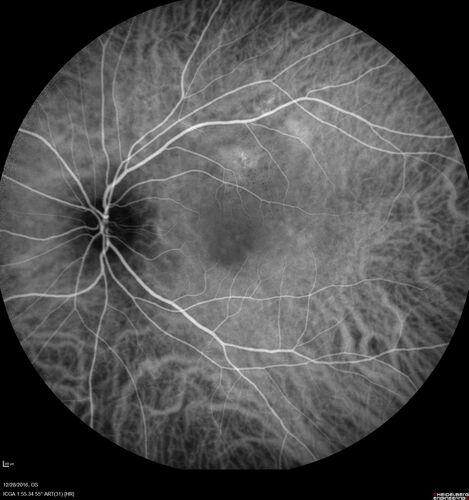 Central Serous Retinopathy - Female on steroids
35 year old female Noticed blurred vision when waking up in the morning.  Also, vision blacks out for a few seconds when she gets up quickly. About 3 months ago she had a history of intermittent vomiting.

VA 20/20 OD, 20/25 OS

MRI normal,  MRA showed lateral sinus thrombosis.  Lupus anticoagulant was positive
