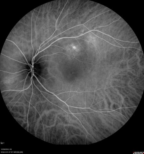 Central Serous Retinopathy - Female on steroids
35 year old female Noticed blurred vision when waking up in the morning.  Also, vision blacks out for a few seconds when she gets up quickly. About 3 months ago she had a history of intermittent vomiting.

VA 20/20 OD, 20/25 OS

MRI normal,  MRA showed lateral sinus thrombosis.  Lupus anticoagulant was positive
