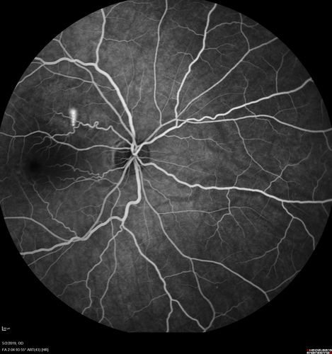Acute Bilateral Central Serous Chorioretinopathy - Female - Smokestack
39 year old female She had no prior epsisodes of vision loss and then a week ago she noticed decreased vision in the right eye.  She has not had any health problems and she is not pregnant.  Phendimetrazine started 3 months ago.  She is not on steroids.   VA OD: sc20/63-1 NscJ16 VA OS: sc20/125-1 Dcc20/80 NscJ16 IOP: TP: OD:14 OS:14 Time:11:23 AM
