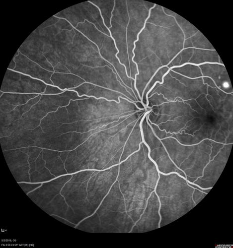 Acute Bilateral Central Serous Chorioretinopathy - Female - Smokestack
39 year old female She had no prior epsisodes of vision loss and then a week ago she noticed decreased vision in the right eye.  She has not had any health problems and she is not pregnant.  Phendimetrazine started 3 months ago.  She is not on steroids.   VA OD: sc20/63-1 NscJ16 VA OS: sc20/125-1 Dcc20/80 NscJ16 IOP: TP: OD:14 OS:14 Time:11:23 AM
