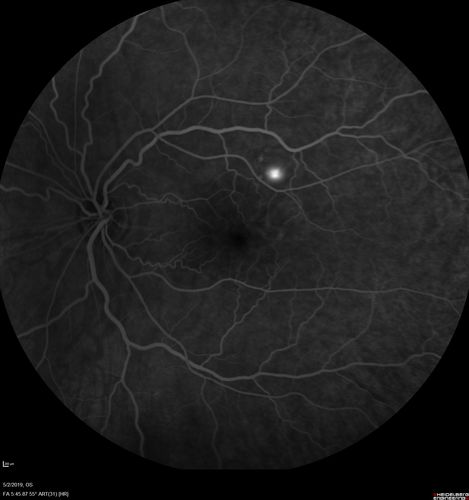 Acute Bilateral Central Serous Chorioretinopathy - Female - Smokestack
39 year old female She had no prior epsisodes of vision loss and then a week ago she noticed decreased vision in the right eye.  She has not had any health problems and she is not pregnant.  Phendimetrazine started 3 months ago.  She is not on steroids.   VA OD: sc20/63-1 NscJ16 VA OS: sc20/125-1 Dcc20/80 NscJ16 IOP: TP: OD:14 OS:14 Time:11:23 AM
