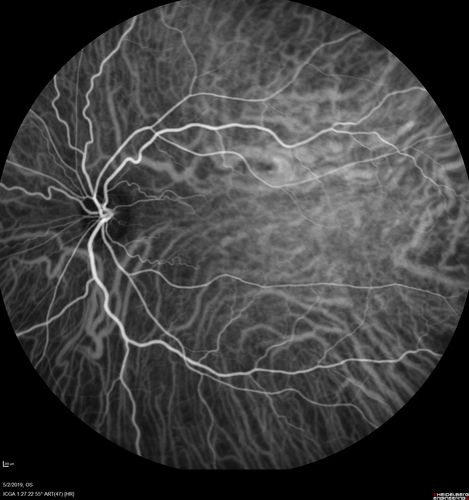 Acute Bilateral Central Serous Chorioretinopathy - Female - Smokestack
39 year old female She had no prior epsisodes of vision loss and then a week ago she noticed decreased vision in the right eye.  She has not had any health problems and she is not pregnant.  Phendimetrazine started 3 months ago.  She is not on steroids.   VA OD: sc20/63-1 NscJ16 VA OS: sc20/125-1 Dcc20/80 NscJ16 IOP: TP: OD:14 OS:14 Time:11:23 AM
