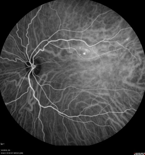 Acute Bilateral Central Serous Chorioretinopathy - Female - Smokestack
39 year old female She had no prior epsisodes of vision loss and then a week ago she noticed decreased vision in the right eye.  She has not had any health problems and she is not pregnant.  Phendimetrazine started 3 months ago.  She is not on steroids.   VA OD: sc20/63-1 NscJ16 VA OS: sc20/125-1 Dcc20/80 NscJ16 IOP: TP: OD:14 OS:14 Time:11:23 AM

