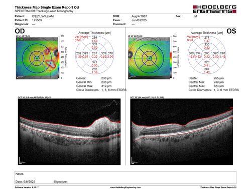 Cotton Wool Spots following cardio-pulmonary bypass
The patient had emergency thoracotomy about 3 weeks ago he had an aortic dissection with a root aneurysm. It had dissected down to the iliacs. The patient had a thoracotomy and aortic valve replacement and large aortic graft.
