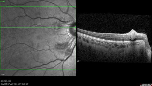 Cotton Wool Spots following cardio-pulmonary bypass
The patient had emergency thoracotomy about 3 weeks ago he had an aortic dissection with a root aneurysm. It had dissected down to the iliacs. The patient had a thoracotomy and aortic valve replacement and large aortic graft.
