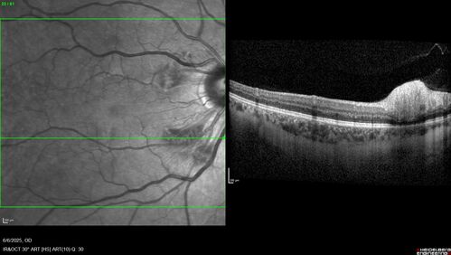 Cotton Wool Spots following cardio-pulmonary bypass
The patient had emergency thoracotomy about 3 weeks ago he had an aortic dissection with a root aneurysm. It had dissected down to the iliacs. The patient had a thoracotomy and aortic valve replacement and large aortic graft.
