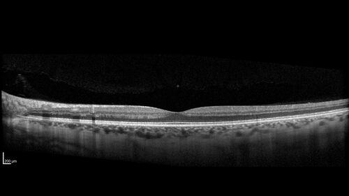 Cotton Wool Spots following cardio-pulmonary bypass
The patient had emergency thoracotomy about 3 weeks ago he had an aortic dissection with a root aneurysm. It had dissected down to the iliacs. The patient had a thoracotomy and aortic valve replacement and large aortic graft.
