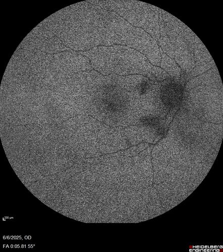 Cotton Wool Spots following cardio-pulmonary bypass
The patient had emergency thoracotomy about 3 weeks ago he had an aortic dissection with a root aneurysm. It had dissected down to the iliacs. The patient had a thoracotomy and aortic valve replacement and large aortic graft.
