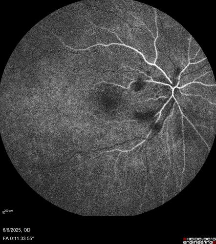 Cotton Wool Spots following cardio-pulmonary bypass
The patient had emergency thoracotomy about 3 weeks ago he had an aortic dissection with a root aneurysm. It had dissected down to the iliacs. The patient had a thoracotomy and aortic valve replacement and large aortic graft.
