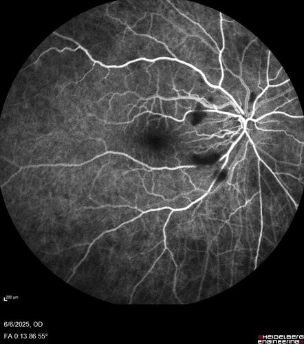 Cotton Wool Spots following cardio-pulmonary bypass
The patient had emergency thoracotomy about 3 weeks ago he had an aortic dissection with a root aneurysm. It had dissected down to the iliacs. The patient had a thoracotomy and aortic valve replacement and large aortic graft.
