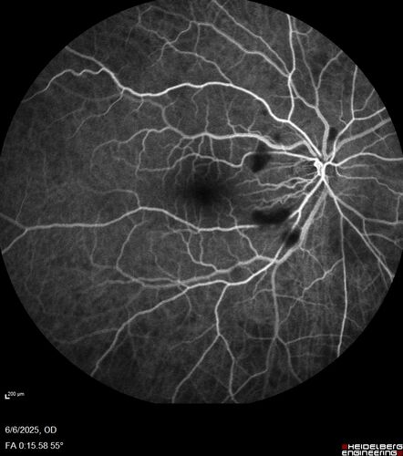 Cotton Wool Spots following cardio-pulmonary bypass
The patient had emergency thoracotomy about 3 weeks ago he had an aortic dissection with a root aneurysm. It had dissected down to the iliacs. The patient had a thoracotomy and aortic valve replacement and large aortic graft.
