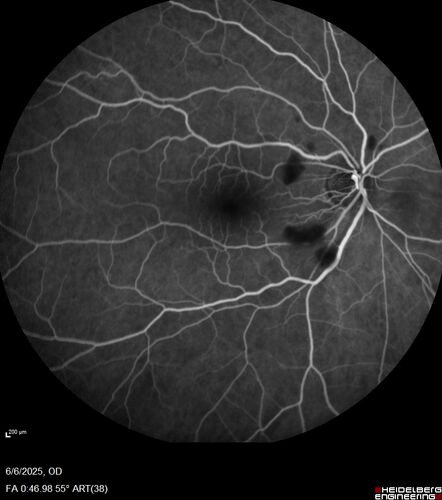 Cotton Wool Spots following cardio-pulmonary bypass
The patient had emergency thoracotomy about 3 weeks ago he had an aortic dissection with a root aneurysm. It had dissected down to the iliacs. The patient had a thoracotomy and aortic valve replacement and large aortic graft.
