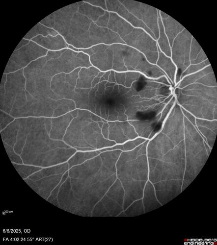 Cotton Wool Spots following cardio-pulmonary bypass
The patient had emergency thoracotomy about 3 weeks ago he had an aortic dissection with a root aneurysm. It had dissected down to the iliacs. The patient had a thoracotomy and aortic valve replacement and large aortic graft.
