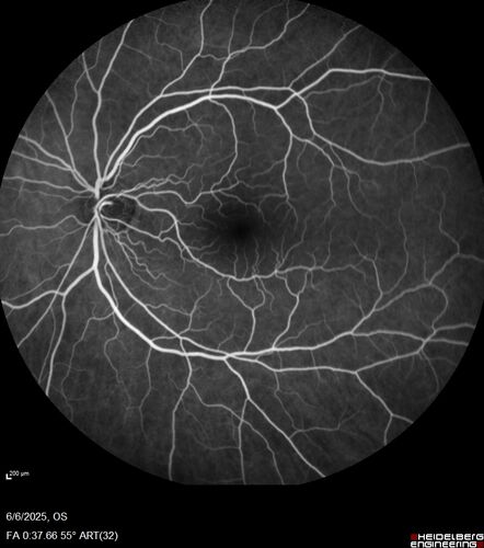 Cotton Wool Spots following cardio-pulmonary bypass
The patient had emergency thoracotomy about 3 weeks ago he had an aortic dissection with a root aneurysm. It had dissected down to the iliacs. The patient had a thoracotomy and aortic valve replacement and large aortic graft.
