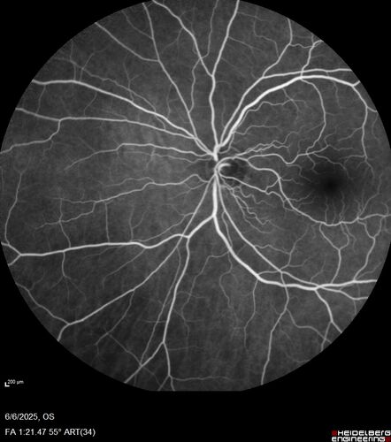 Cotton Wool Spots following cardio-pulmonary bypass
The patient had emergency thoracotomy about 3 weeks ago he had an aortic dissection with a root aneurysm. It had dissected down to the iliacs. The patient had a thoracotomy and aortic valve replacement and large aortic graft.
