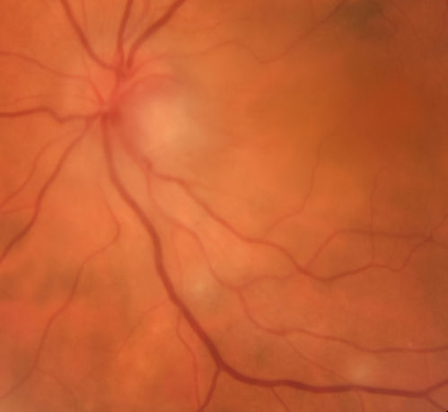 Neuroretinitis and Multifocal Retinitis
62 year old female with vision loss in the left eye to 20/160. Positive Bartonellas IgG.  Vision recovered in 2 months.  She was treated with Oral Erythromycin BID for 2 weeks.
