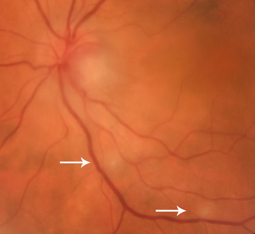 Neuroretinitis and Multifocal Retinitis
62 year old female with vision loss in the left eye to 20/160. Positive Bartonellas IgG.  Vision recovered in 2 months.  She was treated with Oral Erythromycin BID for 2 weeks.
