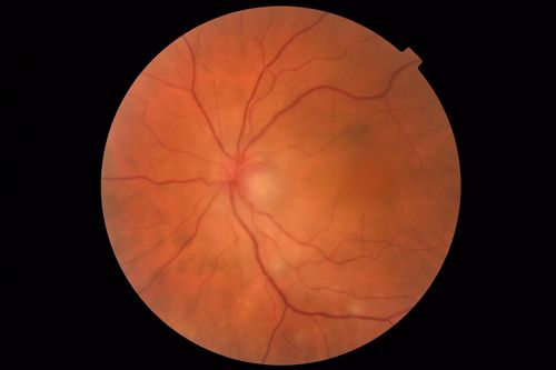 Neuroretinitis and Multifocal Retinitis
62 year old female with vision loss in the left eye to 20/160. Positive Bartonellas IgG.  Vision recovered in 2 months.  She was treated with Oral Erythromycin BID for 2 weeks.
