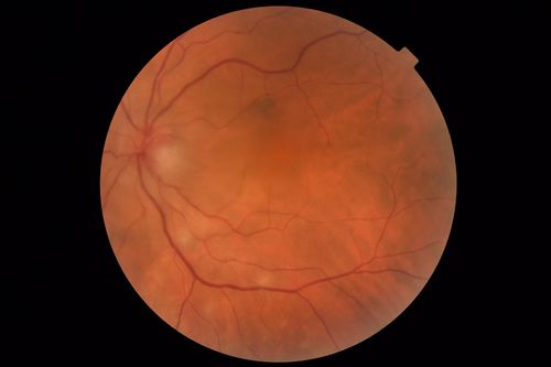 Neuroretinitis and Multifocal Retinitis
62 year old female with vision loss in the left eye to 20/160. Positive Bartonellas IgG.  Vision recovered in 2 months.  She was treated with Oral Erythromycin BID for 2 weeks.
