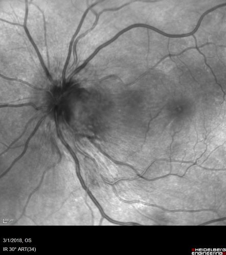 Neuroretinitis and Multifocal Retinitis
62 year old female with vision loss in the left eye to 20/160. Positive Bartonellas IgG.  Vision recovered in 2 months.  She was treated with Oral Erythromycin BID for 2 weeks.

