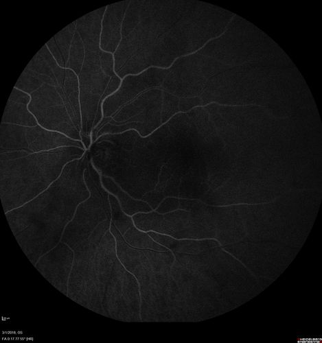 Neuroretinitis and Multifocal Retinitis
62 year old female with vision loss in the left eye to 20/160. Positive Bartonellas IgG.  Vision recovered in 2 months.  She was treated with Oral Erythromycin BID for 2 weeks.
