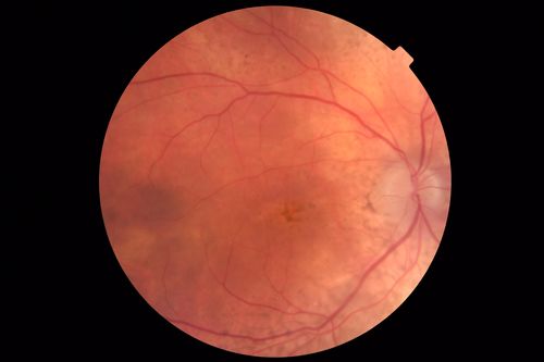 Choroidal Thickening
78 year old man followed for 4 months with choroidal thickening.  Cursory systemic evaluation with no imaging shows no cancer.  Vision is stable or improving.
