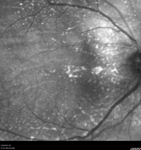 Choroidal Thickening
78 year old man followed for 4 months with choroidal thickening.  Cursory systemic evaluation with no imaging shows no cancer.  Vision is stable or improving.
