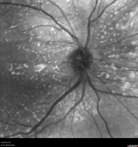Choroidal Thickening
78 year old man followed for 4 months with choroidal thickening.  Cursory systemic evaluation with no imaging shows no cancer.  Vision is stable or improving.
