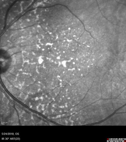 Choroidal Thickening
78 year old man followed for 4 months with choroidal thickening.  Cursory systemic evaluation with no imaging shows no cancer.  Vision is stable or improving.
