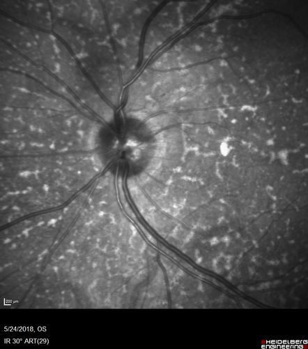 Choroidal Thickening
78 year old man followed for 4 months with choroidal thickening.  Cursory systemic evaluation with no imaging shows no cancer.  Vision is stable or improving.
