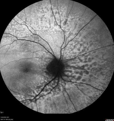 Choroidal Thickening
78 year old man followed for 4 months with choroidal thickening.  Cursory systemic evaluation with no imaging shows no cancer.  Vision is stable or improving.
