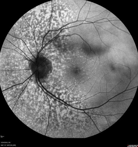 Choroidal Thickening
78 year old man followed for 4 months with choroidal thickening.  Cursory systemic evaluation with no imaging shows no cancer.  Vision is stable or improving.
