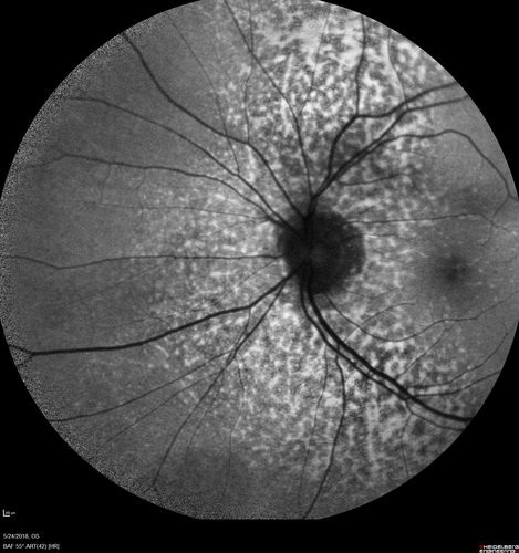 Choroidal Thickening
78 year old man followed for 4 months with choroidal thickening.  Cursory systemic evaluation with no imaging shows no cancer.  Vision is stable or improving.
