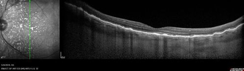 Choroidal Thickening
78 year old man followed for 4 months with choroidal thickening.  Cursory systemic evaluation with no imaging shows no cancer.  Vision is stable or improving.
