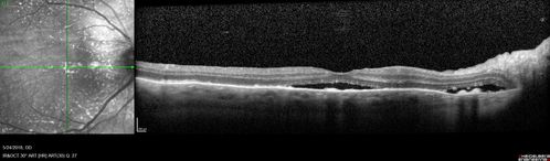 Choroidal Thickening
78 year old man followed for 4 months with choroidal thickening.  Cursory systemic evaluation with no imaging shows no cancer.  Vision is stable or improving.
