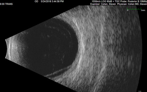 Choroidal Thickening
78 year old man followed for 4 months with choroidal thickening.  Cursory systemic evaluation with no imaging shows no cancer.  Vision is stable or improving.
