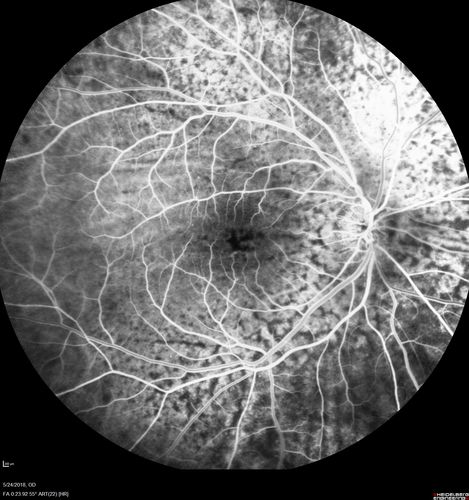 Choroidal Thickening
78 year old man followed for 4 months with choroidal thickening.  Cursory systemic evaluation with no imaging shows no cancer.  Vision is stable or improving.
