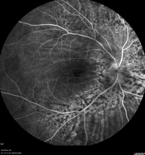 Choroidal Thickening
78 year old man followed for 4 months with choroidal thickening.  Cursory systemic evaluation with no imaging shows no cancer.  Vision is stable or improving.
