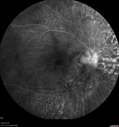 Choroidal Thickening
78 year old man followed for 4 months with choroidal thickening.  Cursory systemic evaluation with no imaging shows no cancer.  Vision is stable or improving.
