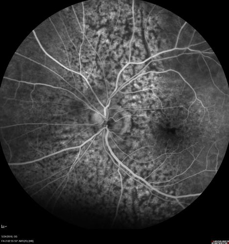 Choroidal Thickening
78 year old man followed for 4 months with choroidal thickening.  Cursory systemic evaluation with no imaging shows no cancer.  Vision is stable or improving.
