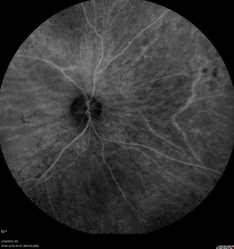 Choroidal Thickening
78 year old man followed for 4 months with choroidal thickening.  Cursory systemic evaluation with no imaging shows no cancer.  Vision is stable or improving.

