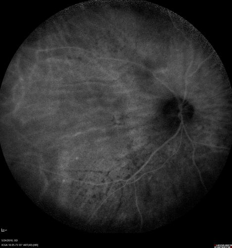 Choroidal Thickening
78 year old man followed for 4 months with choroidal thickening.  Cursory systemic evaluation with no imaging shows no cancer.  Vision is stable or improving.
