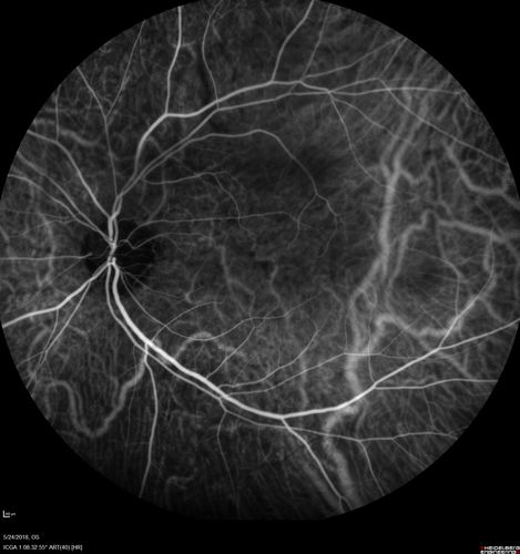 Choroidal Thickening
78 year old man followed for 4 months with choroidal thickening.  Cursory systemic evaluation with no imaging shows no cancer.  Vision is stable or improving.
