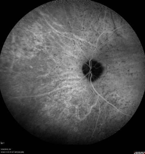 Choroidal Thickening
78 year old man followed for 4 months with choroidal thickening.  Cursory systemic evaluation with no imaging shows no cancer.  Vision is stable or improving.
