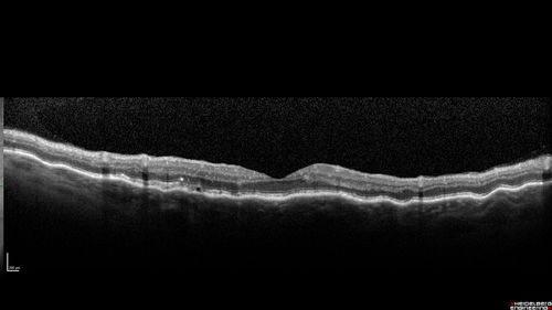 Choroidal Effusions following Glaucoma Surgery 9 months ago
67 year old female with glaucoma surgery 9 month ago.  Her IOP is 12.  She has peripheral choroidal effusions.  VA 20/100 ph 20/32
