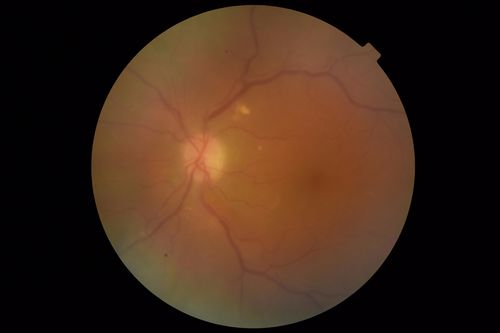 Chronic Endophthalmitis and Cystoid Macular Edema
VA 20/50 - Culture negative. Cleared with intravitreal antibiotics and decadron
