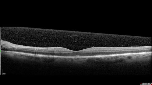 Chronic Endophthalmitis and Cystoid Macular Edema
VA 20/50 - Culture negative. Cleared with intravitreal antibiotics and decadron
